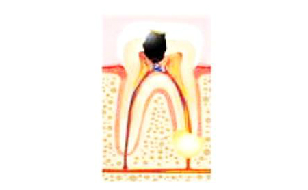 Diente con caries en Espacio Dental Jaén