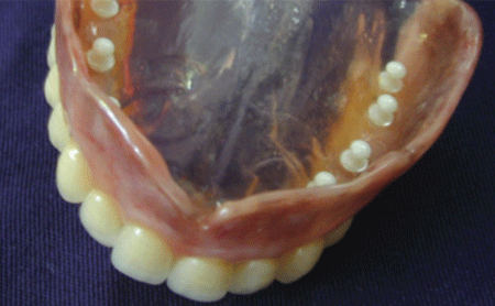 Prótesis completa superior con anclajes 3 - Espacio Dental Jaén