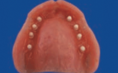 Prótesis completa superior - Espacio Dental Jaén
