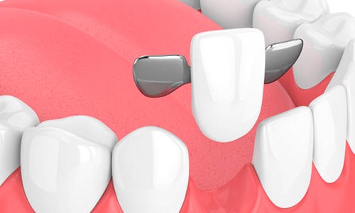 Puentes Dentales - Espacio Dental Jaén