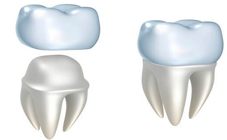 Coronas dentales - Espacio Dental en Jaén