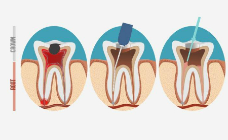 Endodoncia en Jaén en Espacio Dental Jaén