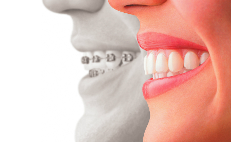 Ortodoncia en Jaén en Espacio Dental Jaén