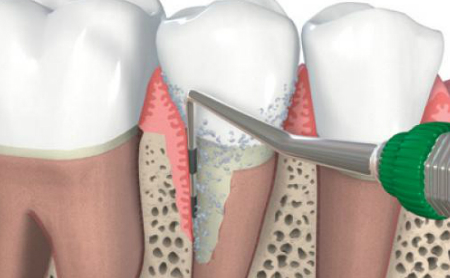 Tratamientos de Periodoncia en Jaén en Espacio Dental Jaén