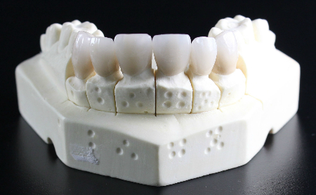 Tratamientos de Prótesis Dentales Jaén en Espacio Dental Jaén